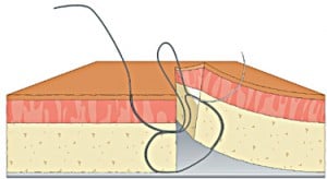 figure 8 suture step 6