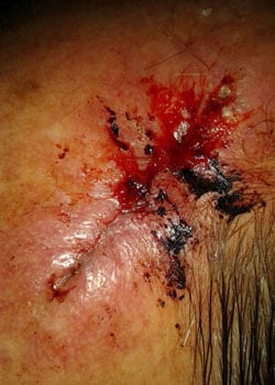 Wound dehiscence