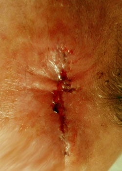 Wound dehiscence