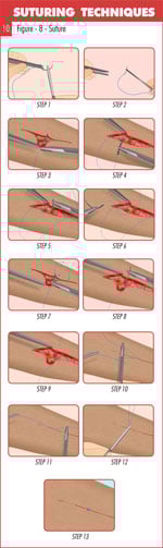 Figure_8_suture_technique