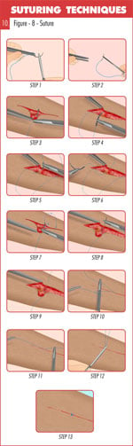 Figure_8_suture_technique