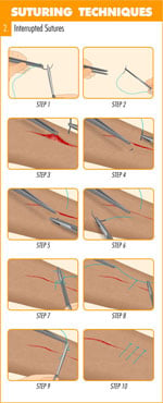 Interrupted_sutures_suture_technique