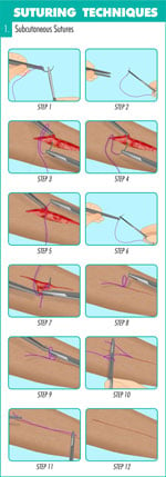 Subcutaneous_sutures_suturing-techniques
