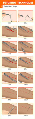 far_and_near_suture_technique